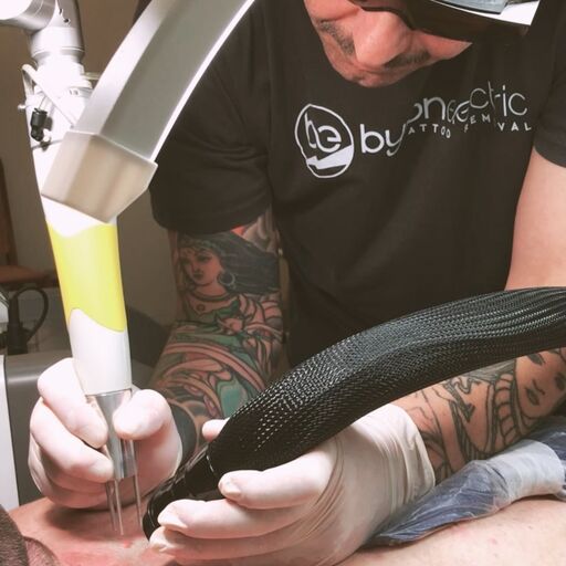 @byrontattooremoval Profile Picture