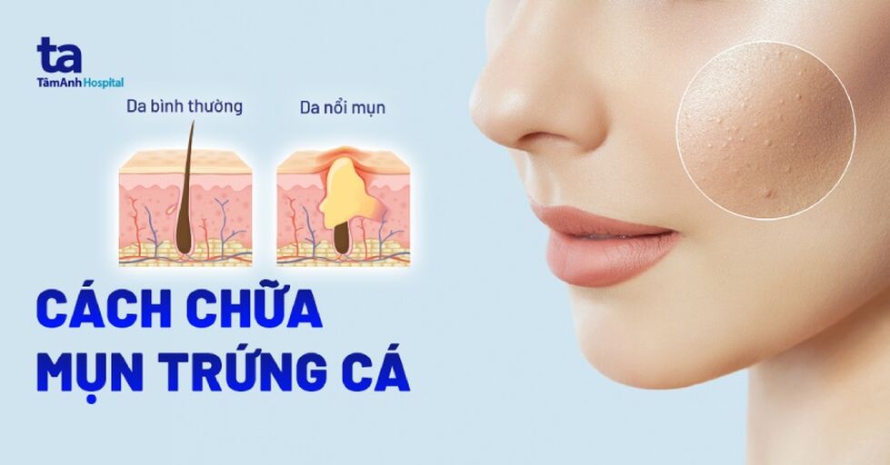 @cachtrimuntrungca Profile Picture