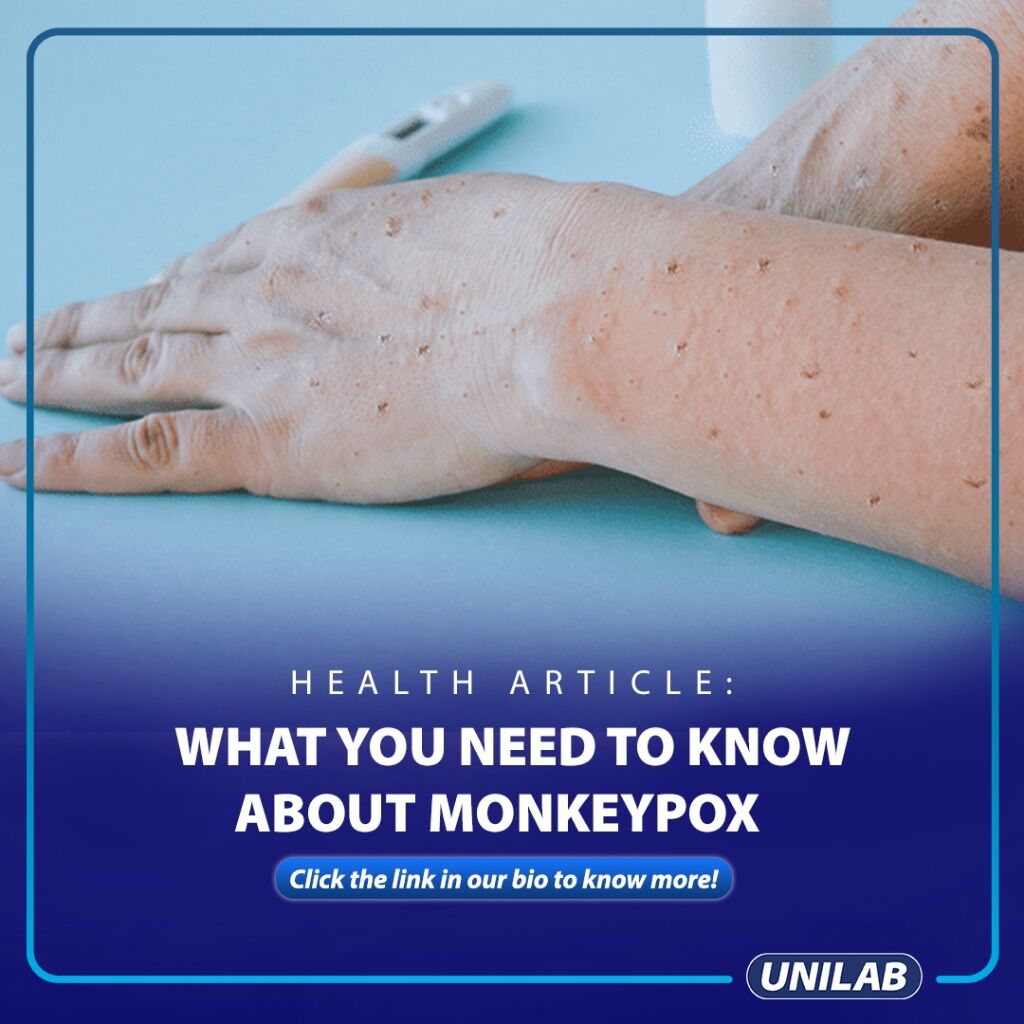 What You Need to Know About Monkeypox