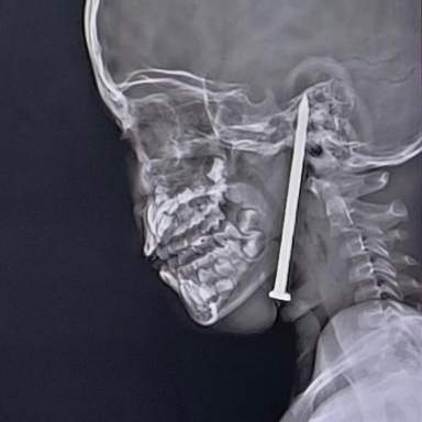 Seven-year-old boy has three-inch nail removed from his BRAIN by incredible surgeons after he fell on it in horrific India playtime accident | Daily Mail Online