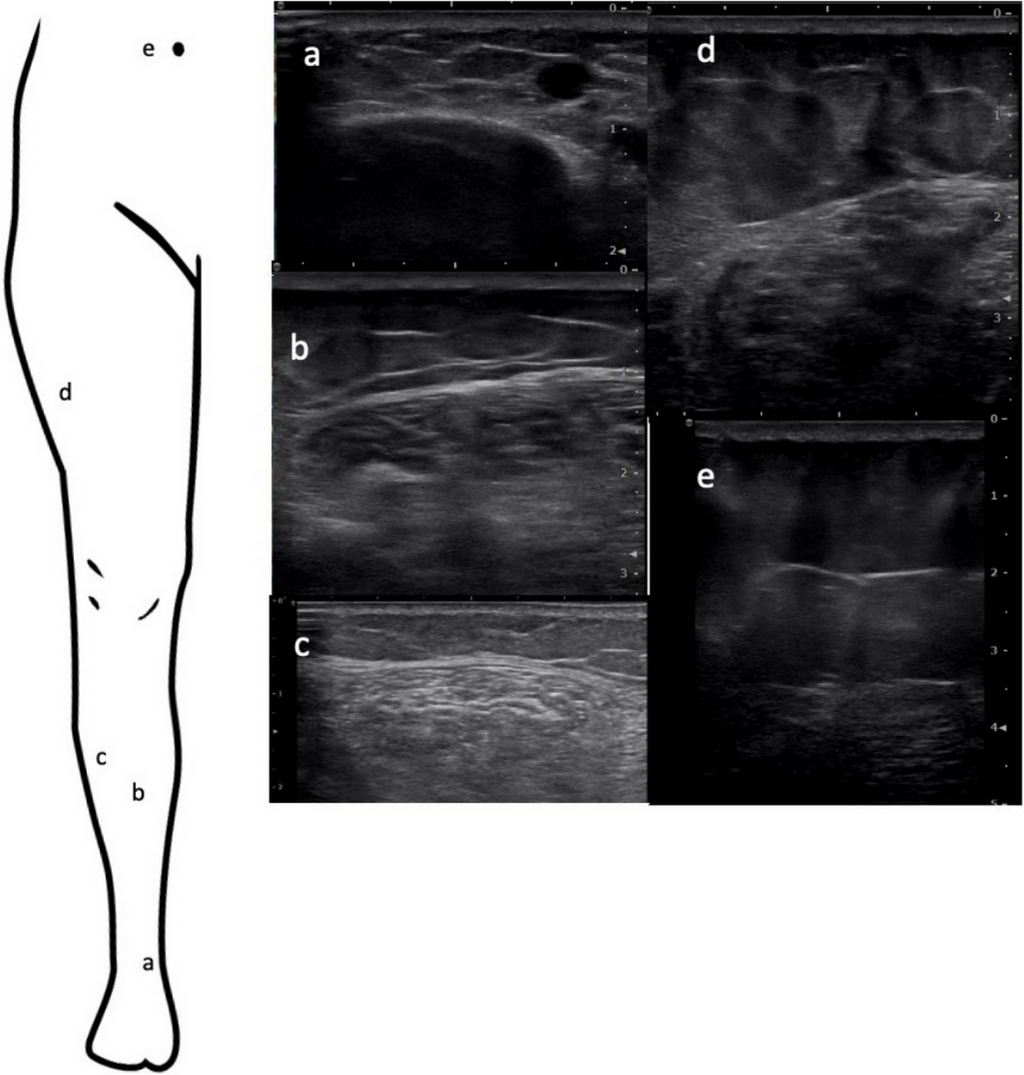 Intersection between hypermobile Ehlers-Danlos syndrome and adipose disorders: investigating fascial remodeling with ultrasound imaging - Journal of Rare Diseases