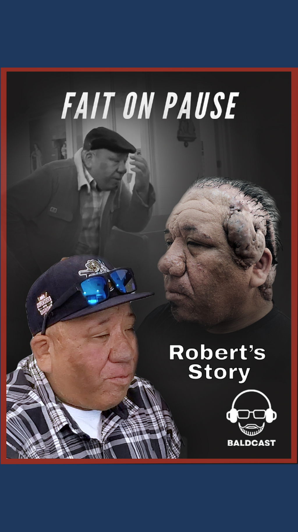 How Giant Scalp Keloids Came Between Robert and God Chapter 5 of Episode 2 of the Baldcast
