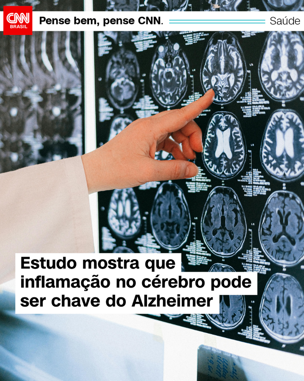 Estudo mostra que inflama&ccedil;&atilde;o no c&eacute;rebro pode ser chave do Alzheimer