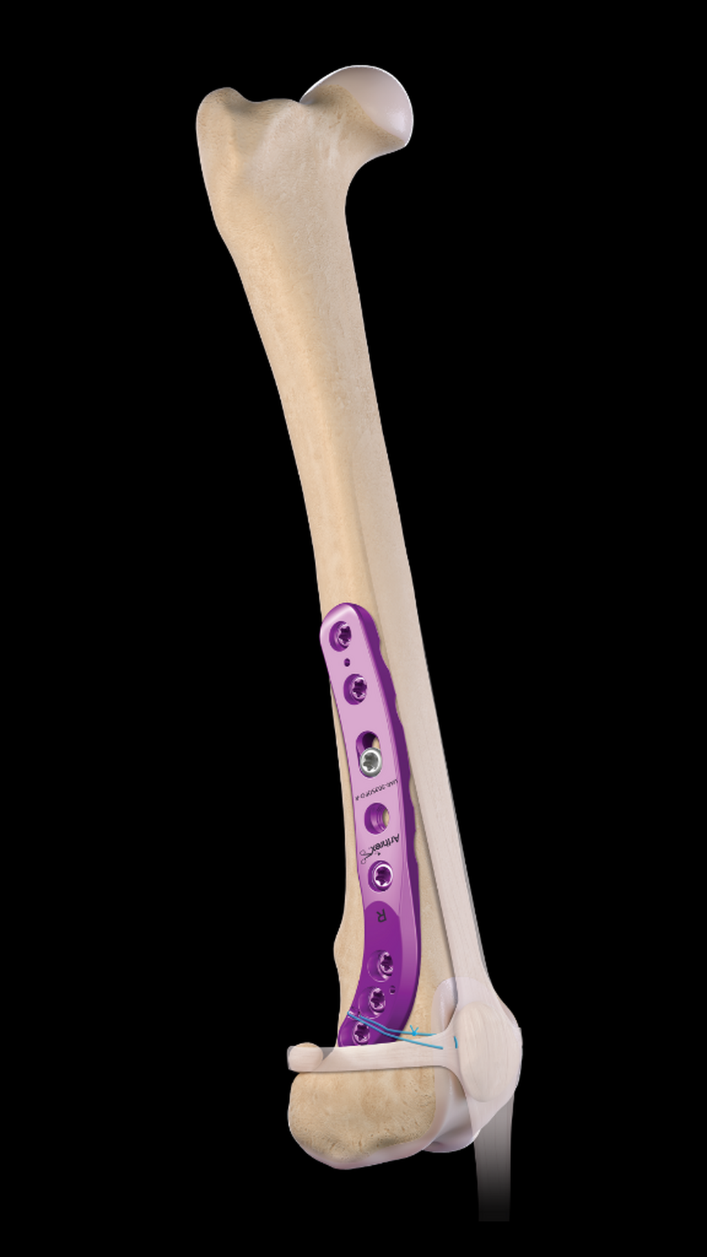 Case Planning Considerations for the Distal Femoral Osteotomy