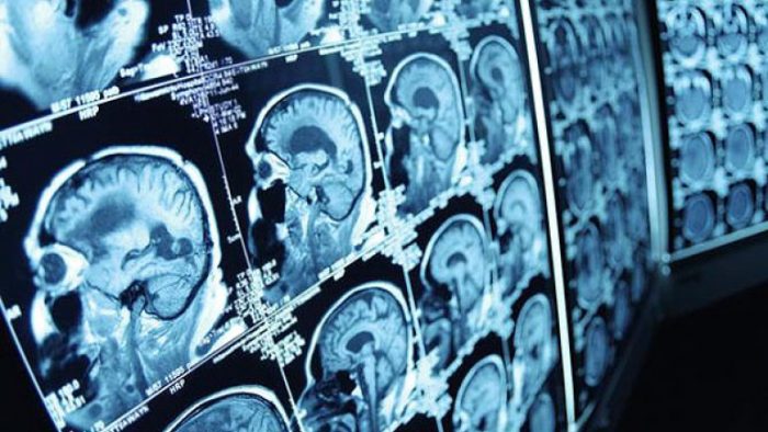 En el cerebro y en el mundo: todo diverso en todas partes al mismo tiempo