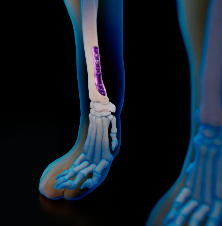 OrthoLine&trade; Radial Fracture System