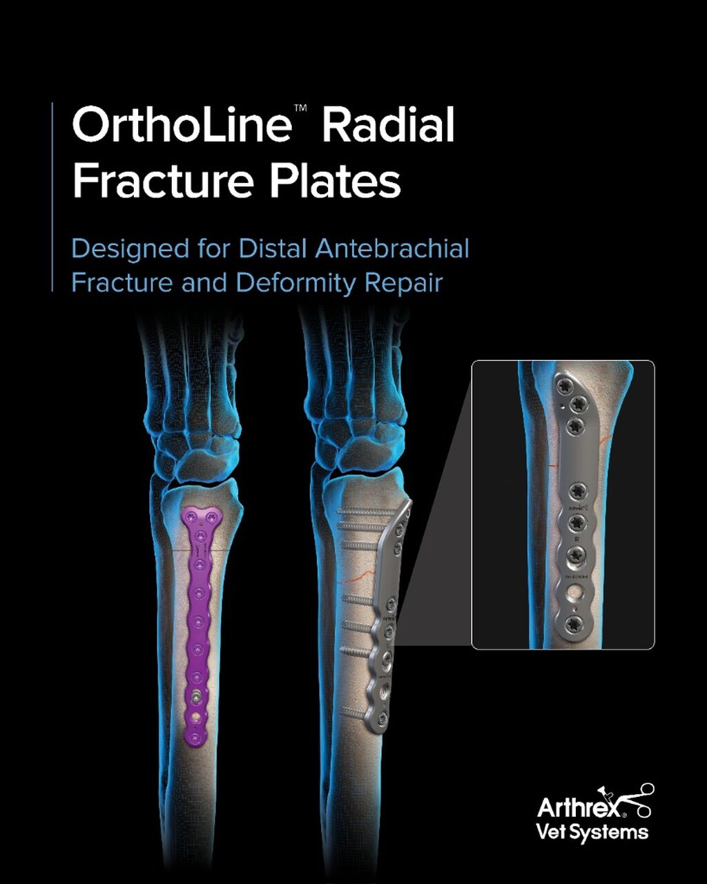 OrthoLine&trade; Radial Fracture System