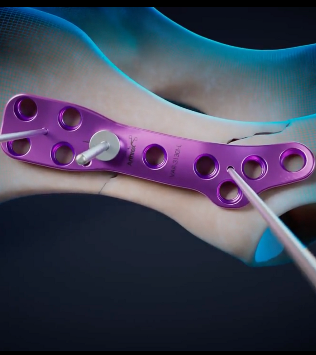 OrthoLine&trade; Ilial Fracture Management System