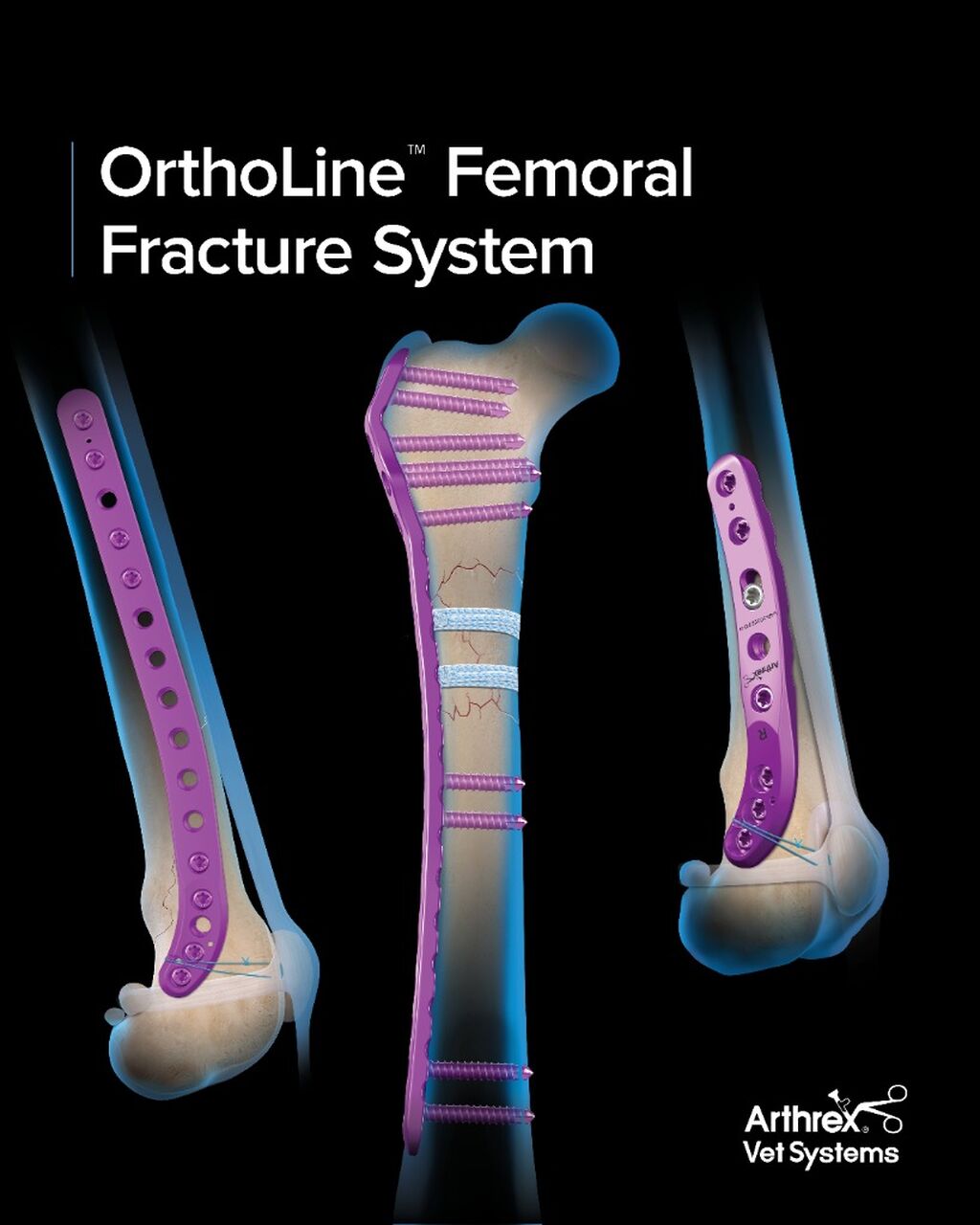 OrthoLine&trade; Femur Fracture System
