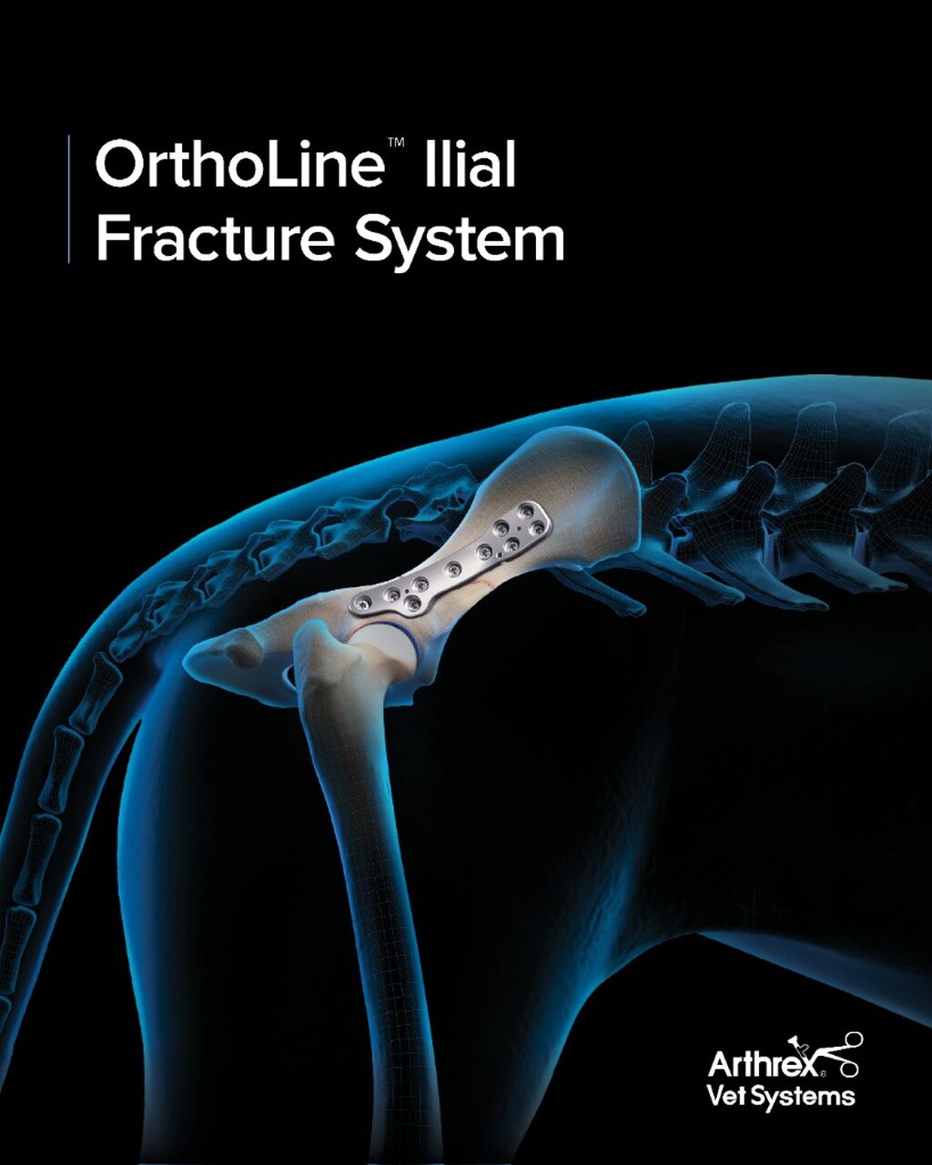 OrthoLine&trade; Illial Fracture System