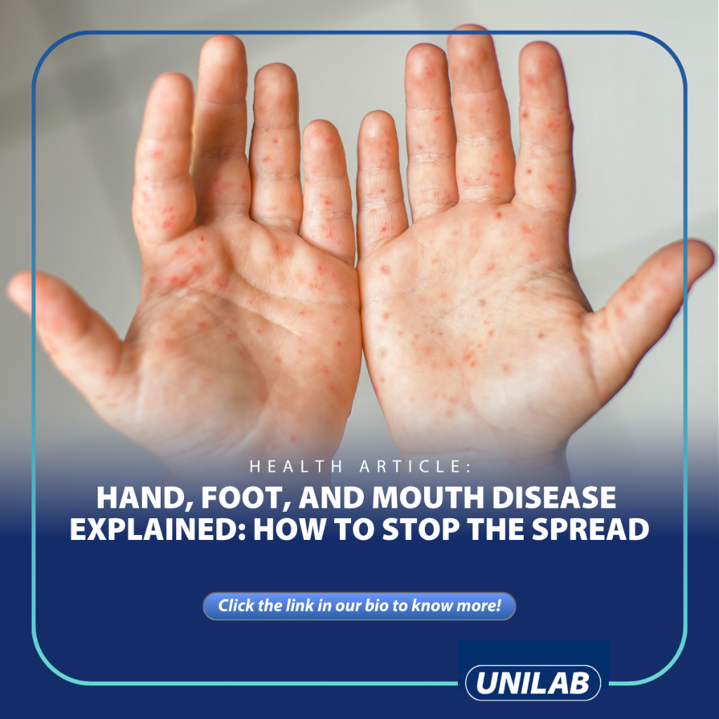Hand, Foot, and Mouth Disease Explained: How to Stop the Spread