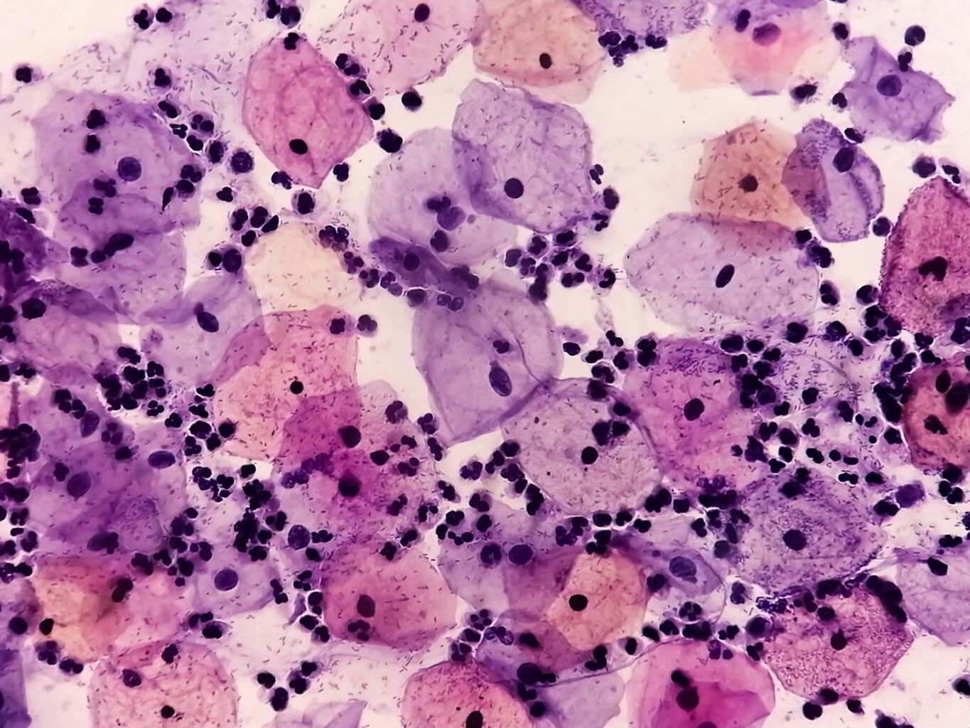 UF researchers work to enhance HPV self-testing to screen for cervical cancer