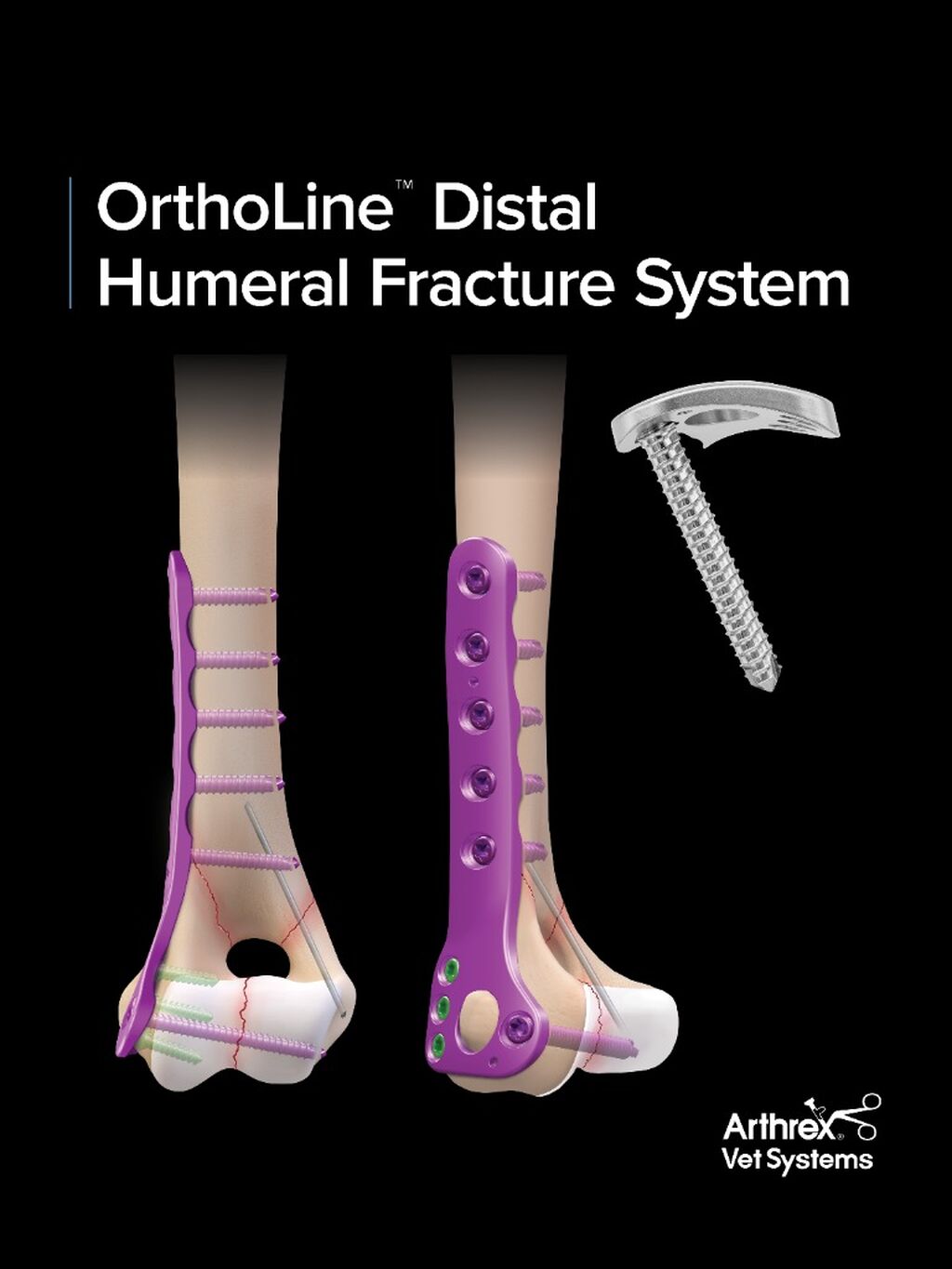 OrthoLine&trade; Distal Humeral Fracture System