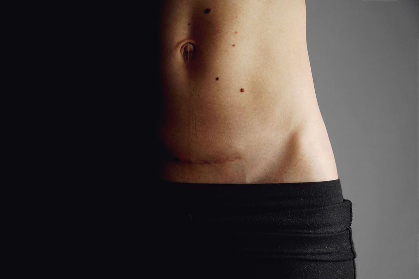 The Long-Lasting Effects of C-Section