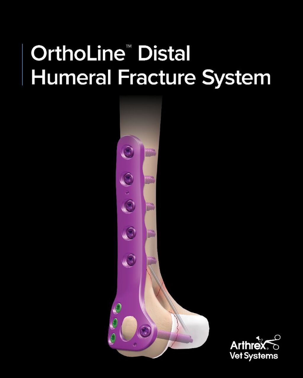 OrthoLine&trade; Distal Humeral Fracture System