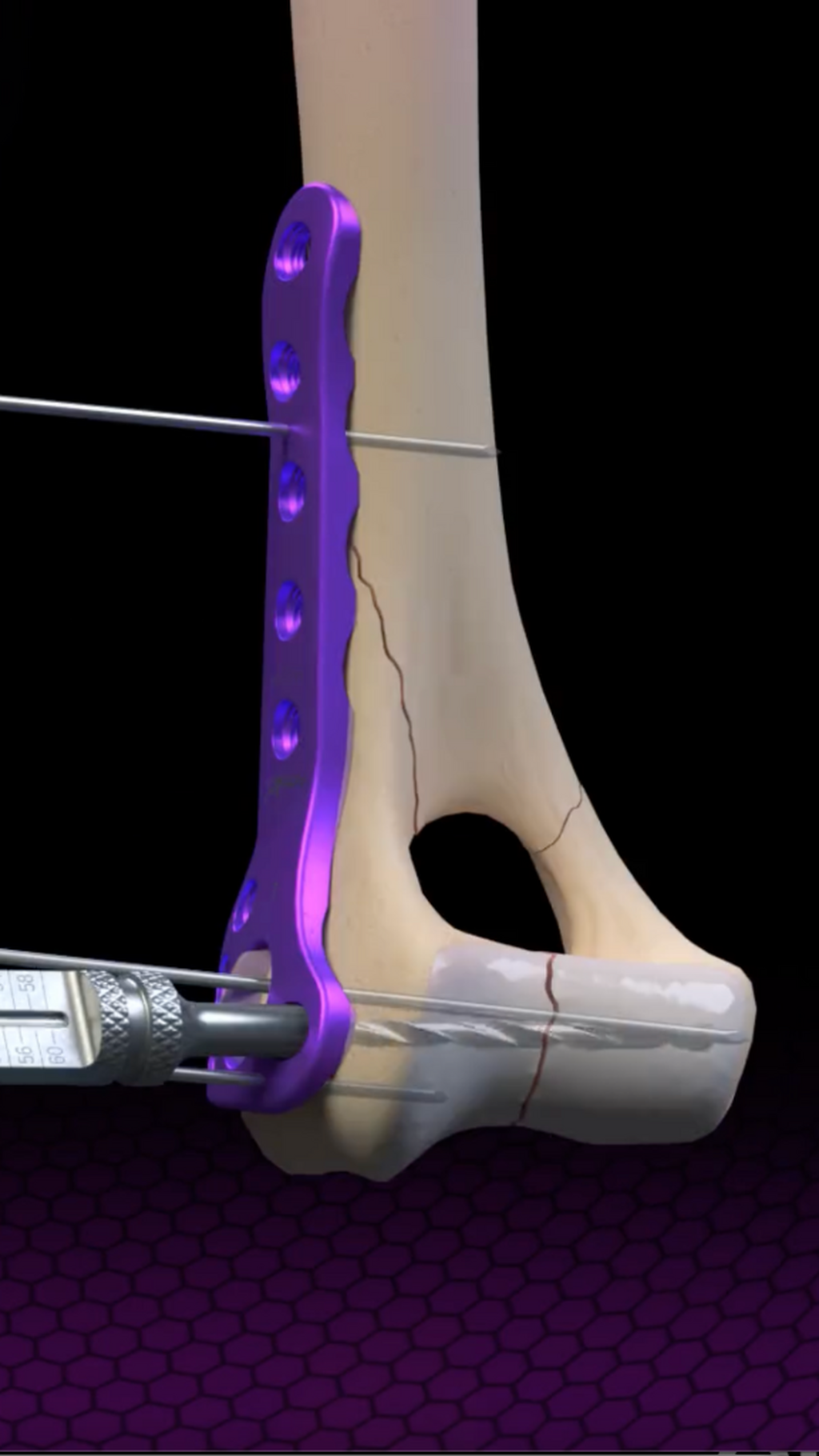 OrthoLine&trade; Distal Humeral Fracture System