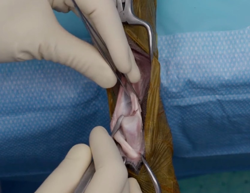 Achilles Tendon Insertional Partial Repair With Double-Armed FiberWire&reg; Suture and a Fixation Button