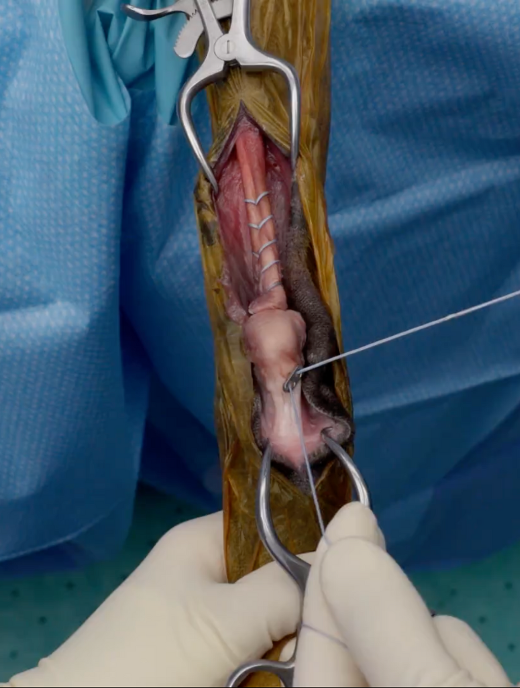 Achilles Tendon Repair Using FiberLoop&reg; Suture With a Two-Hole Button