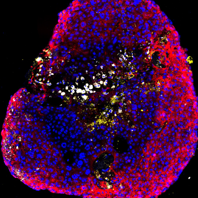𝘕𝘦𝘶𝘳𝘰-𝘖𝘯𝘤𝘰𝘭𝘰𝘨𝘺: Stable isotope tracing in human plasma-like medium reveals metabolic and immune modulation of the glioblastoma microenvironment