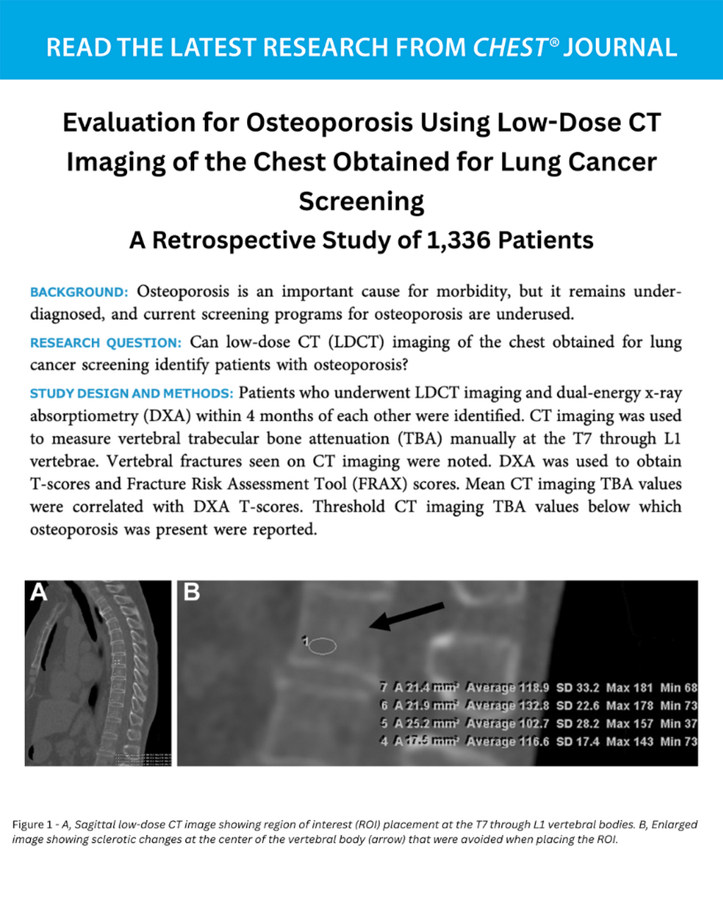 Evaluation for Osteoporosis Using Low-Dose CT Imaging of the Chest Obtained for Lung Cancer Screening: A Retrospective Study of 1,336 Patients