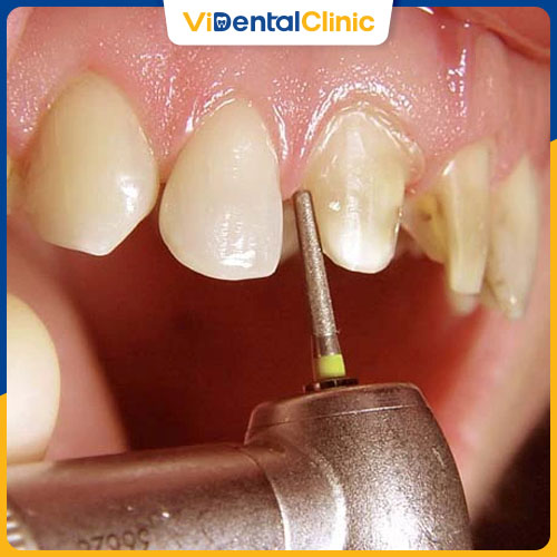 Sau Sinh Bao L&acirc;u Th&igrave; Trồng Răng Được?