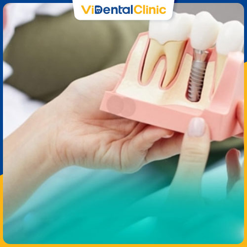 3 Phương Ph&aacute;p Trồng Răng: Giải Ph&aacute;p Tốt Nhất Cho H&agrave;m Răng Của Bạn