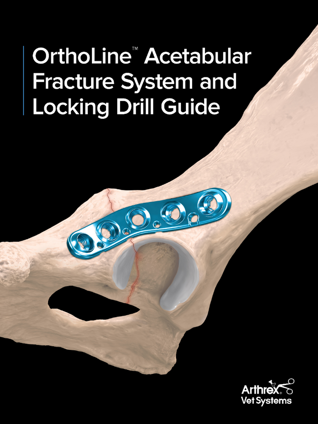 OrthoLine&trade; Acetabular Plates