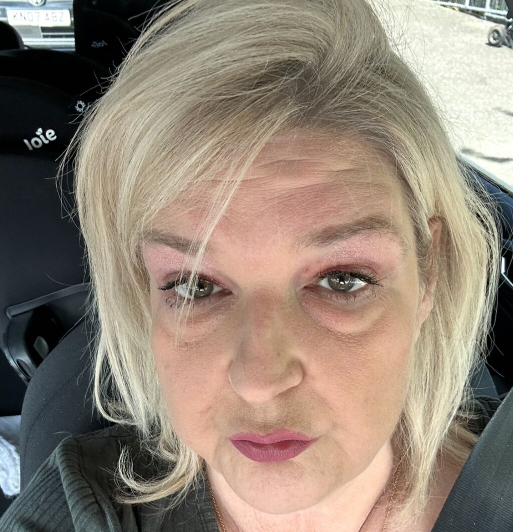 Spontaneity and Living with Lupus &ndash; By Terri