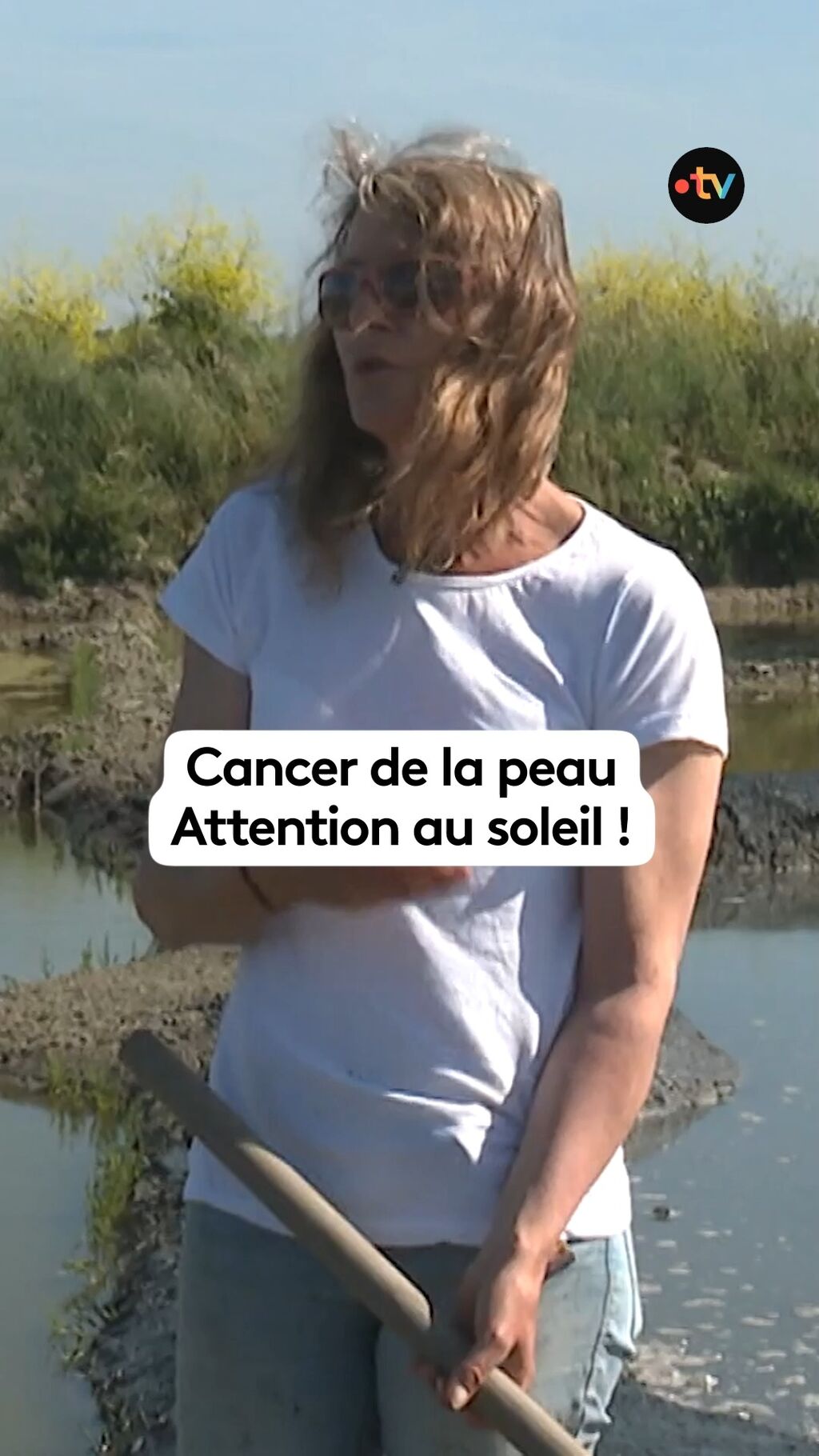 T&acirc;ches brunes, vilain grain de beaut&eacute;, comment d&eacute;tecter et pr&eacute;venir les cancers de la peau face au manque de dermatologues ?