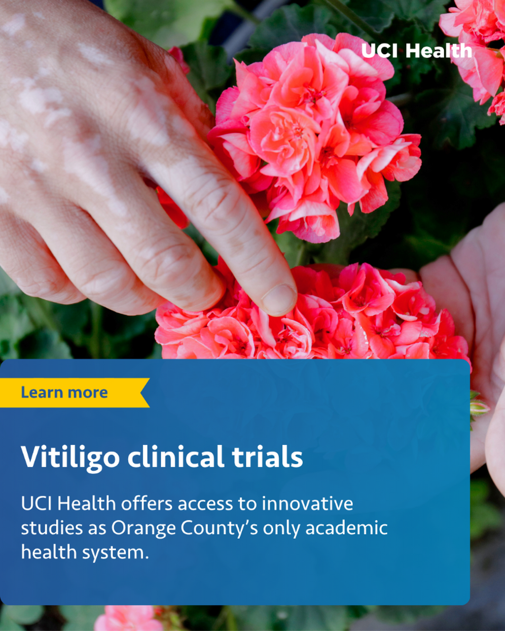July Clinical Trials Vitiligo
