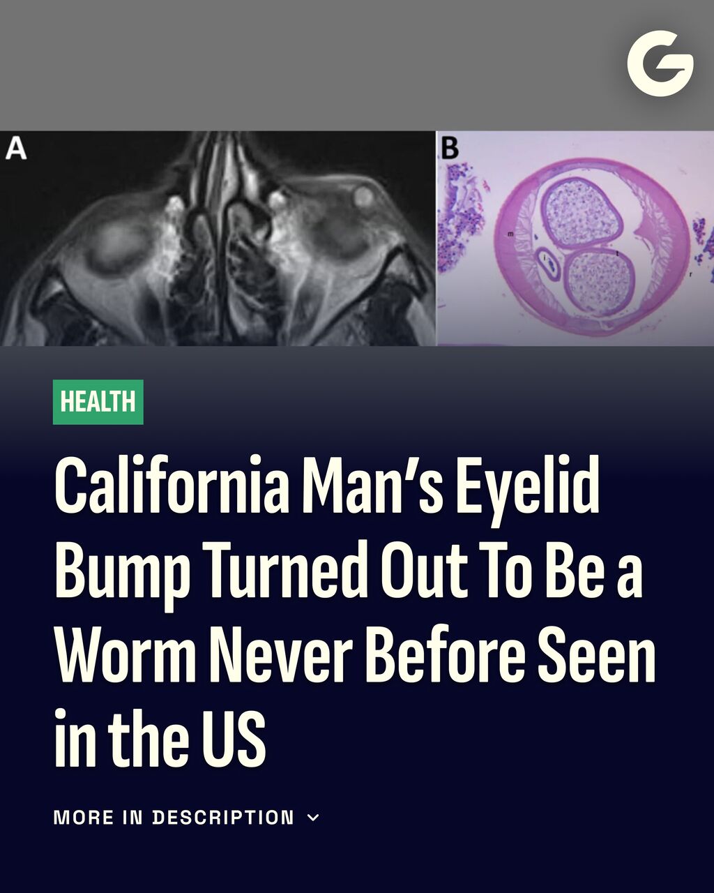 California Man&rsquo;s Eyelid Bump Turned Out To Be a Worm Never Before Seen in the US