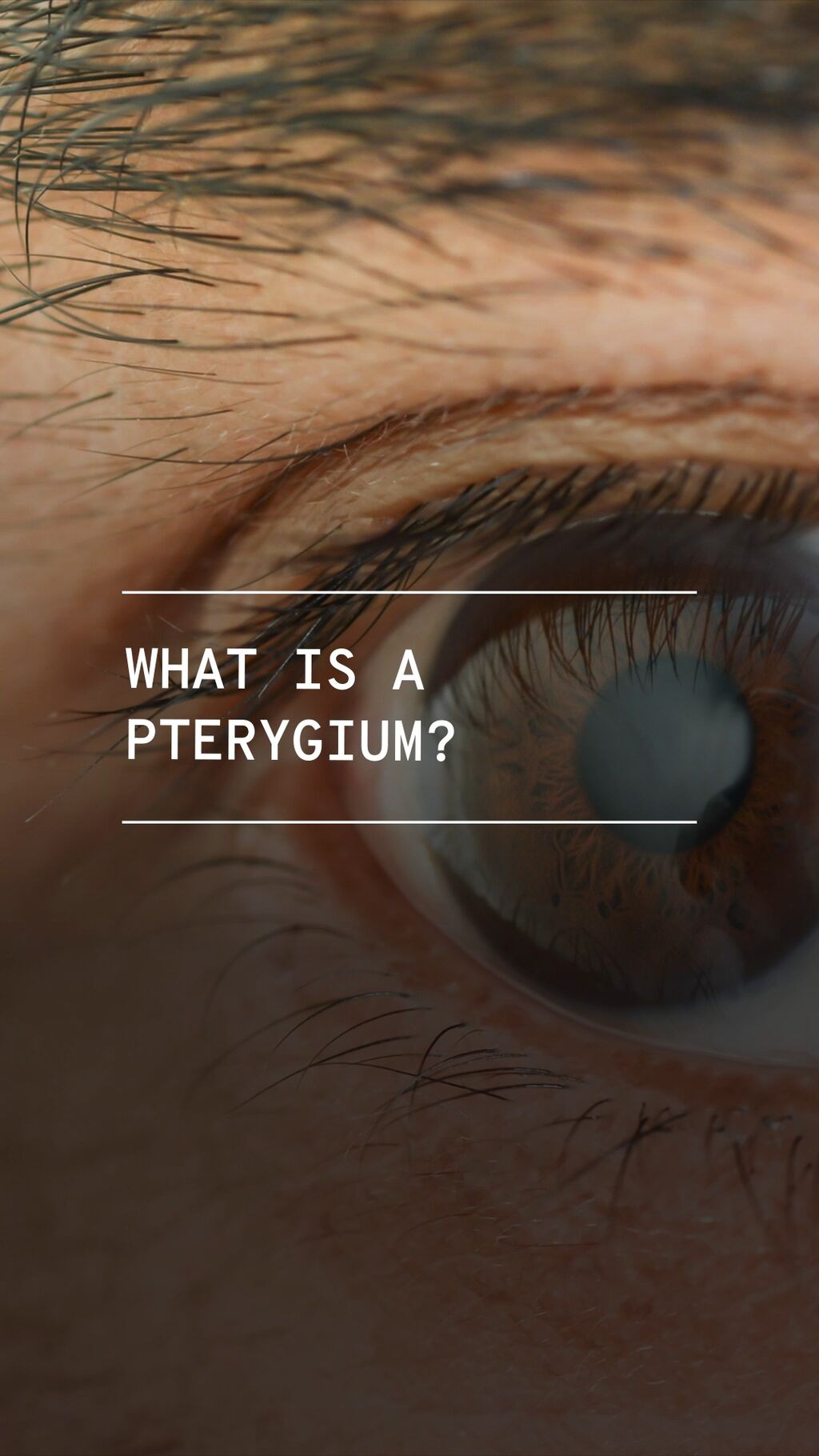 Pterygium