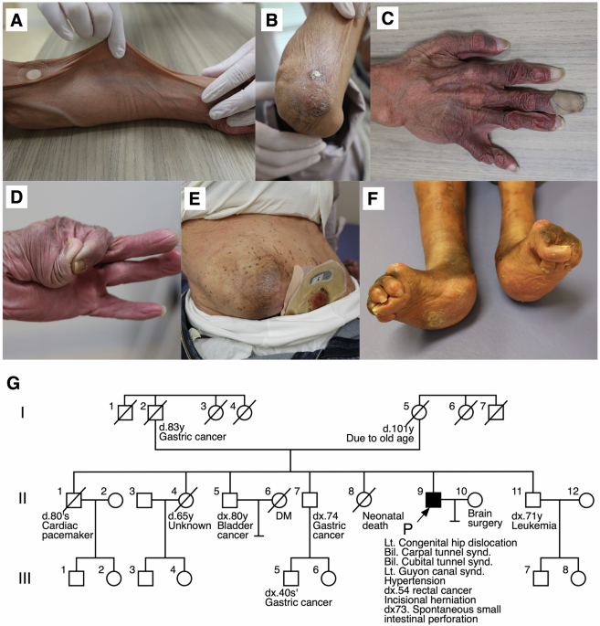 Gastrointestinal involvement in EDS classical-like type 2 associated with a novel AEBP1 splice-site variant - Journal of Human Genetics