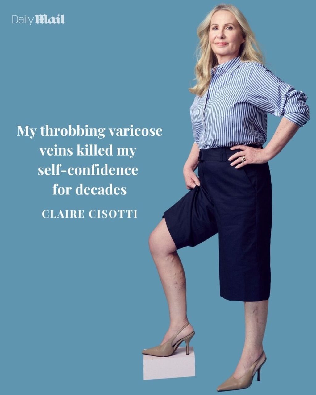 My varicose vein transformation 