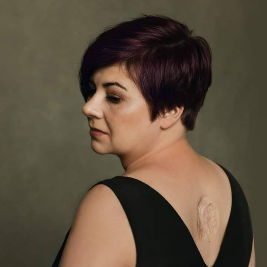 How I was Diagnosed with METASTATIC MELANOMA! "I Thought it Was a Birthmark"
