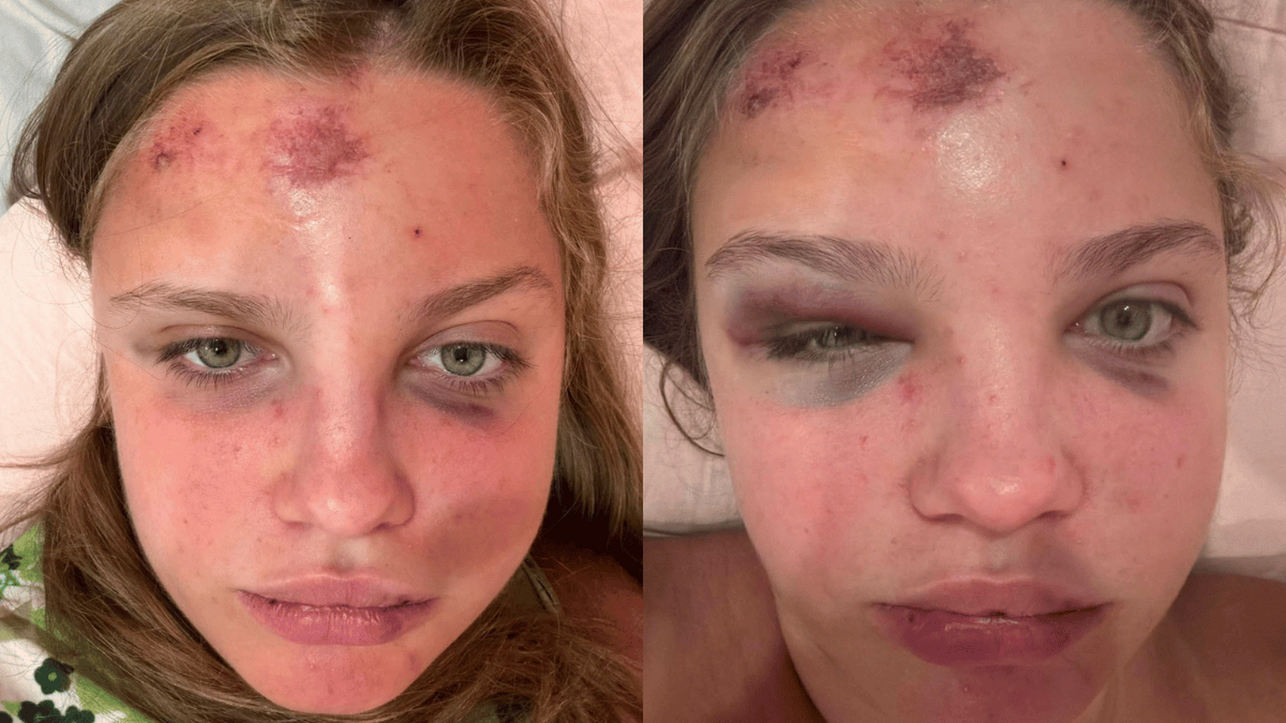 Victim speaks out after being robbed and brutally assaulted in Vancouver's Downtown Eastside