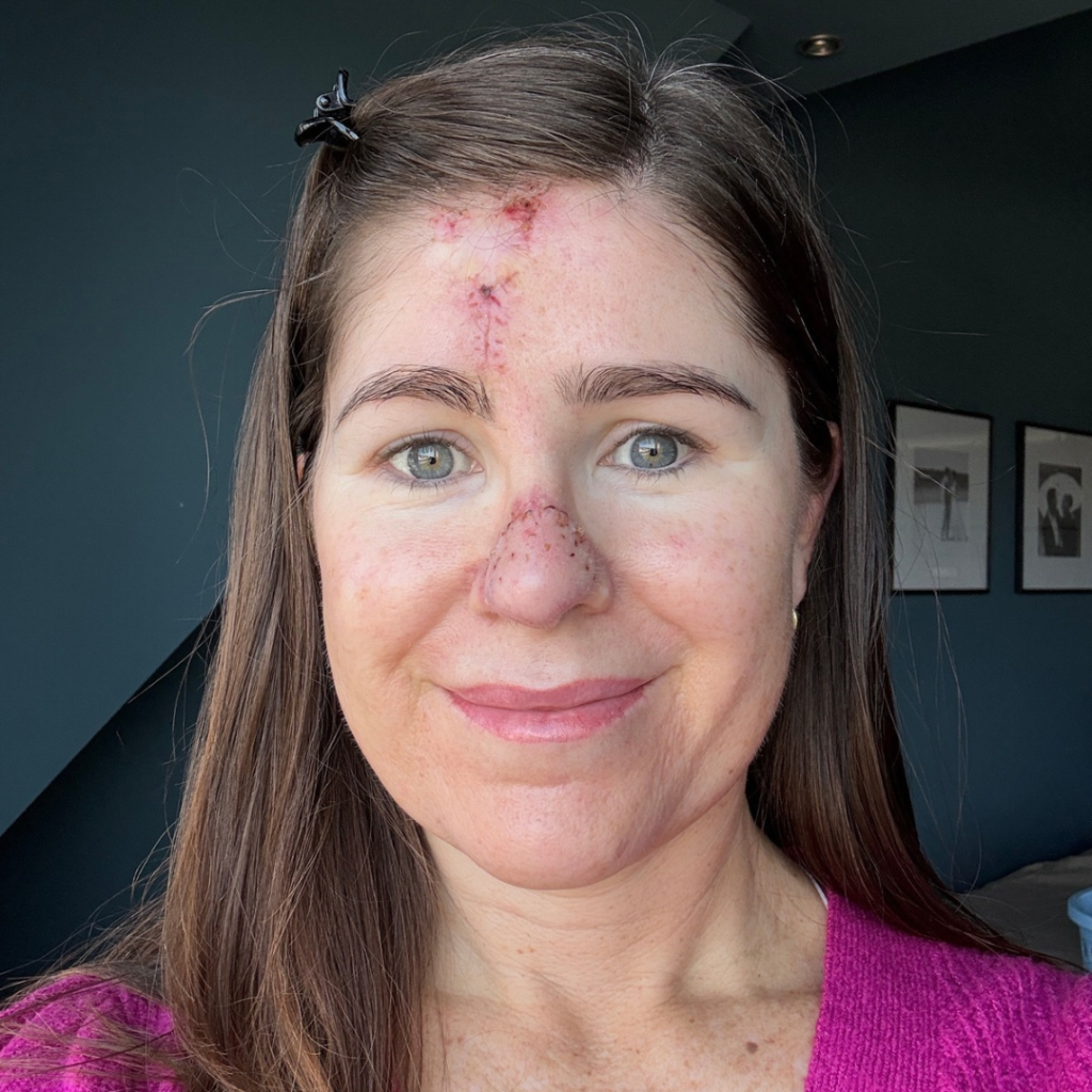 I Thought It Was A PIMPLE But it Was SKIN CANCER!