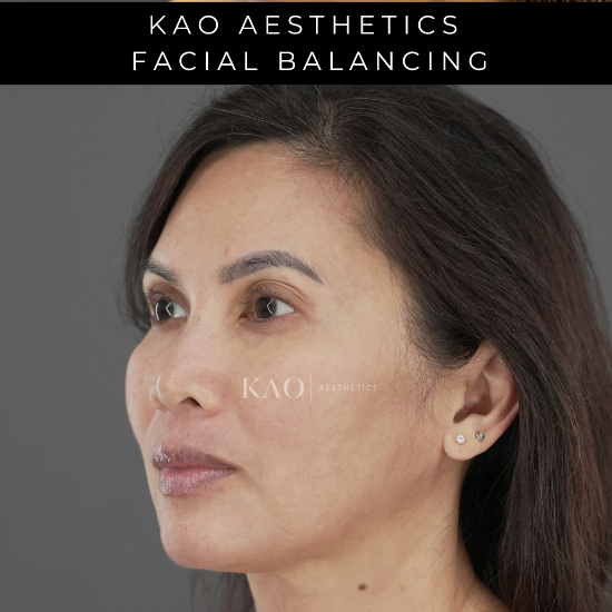 Facial Balancing 