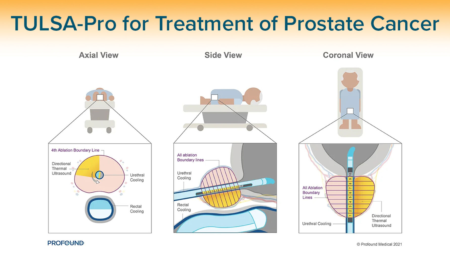 TULSA-Pro for Prostate Cancer
