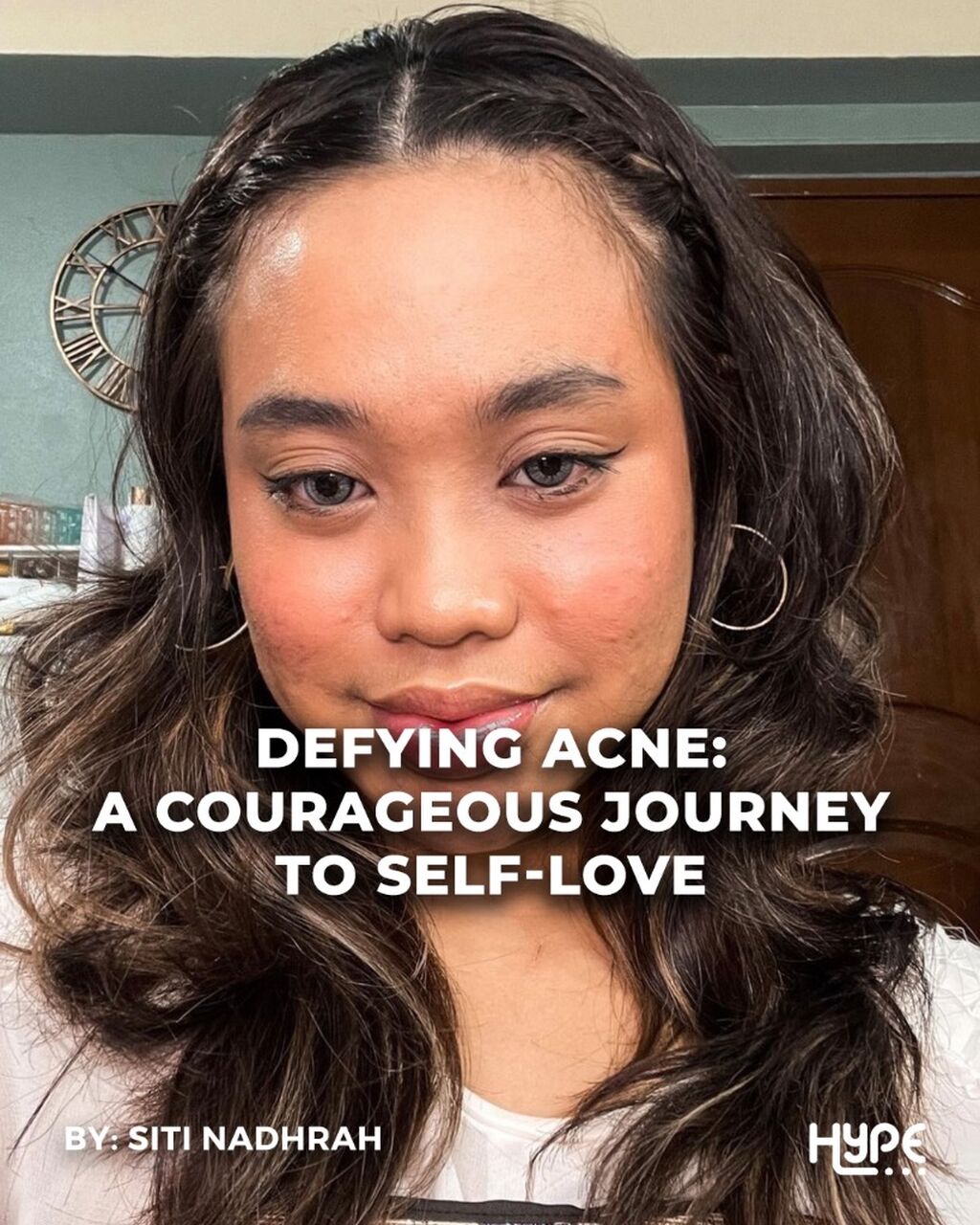Defying Acne: A Courageous Journey to Self-Love