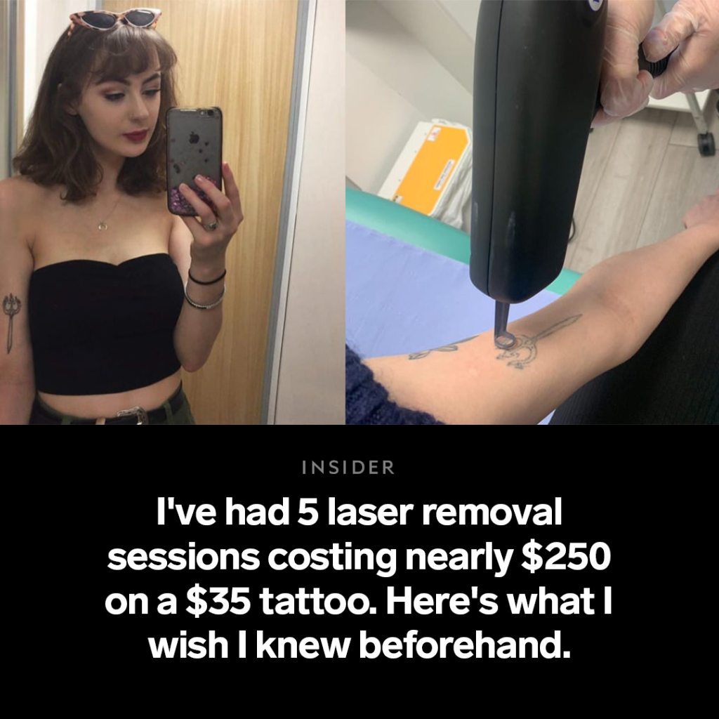 I've had 5 laser removal sessions costing nearly $250 on a $35 tattoo. Here's what I wish I knew beforehand.