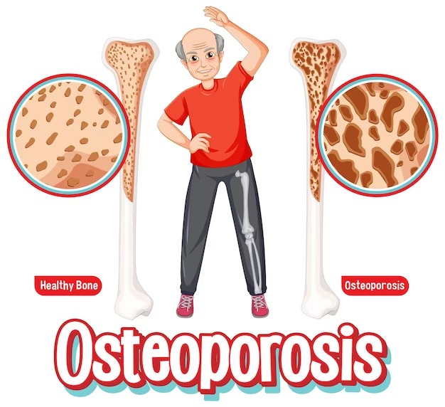 Osteoporosis - The Bone Density Solution