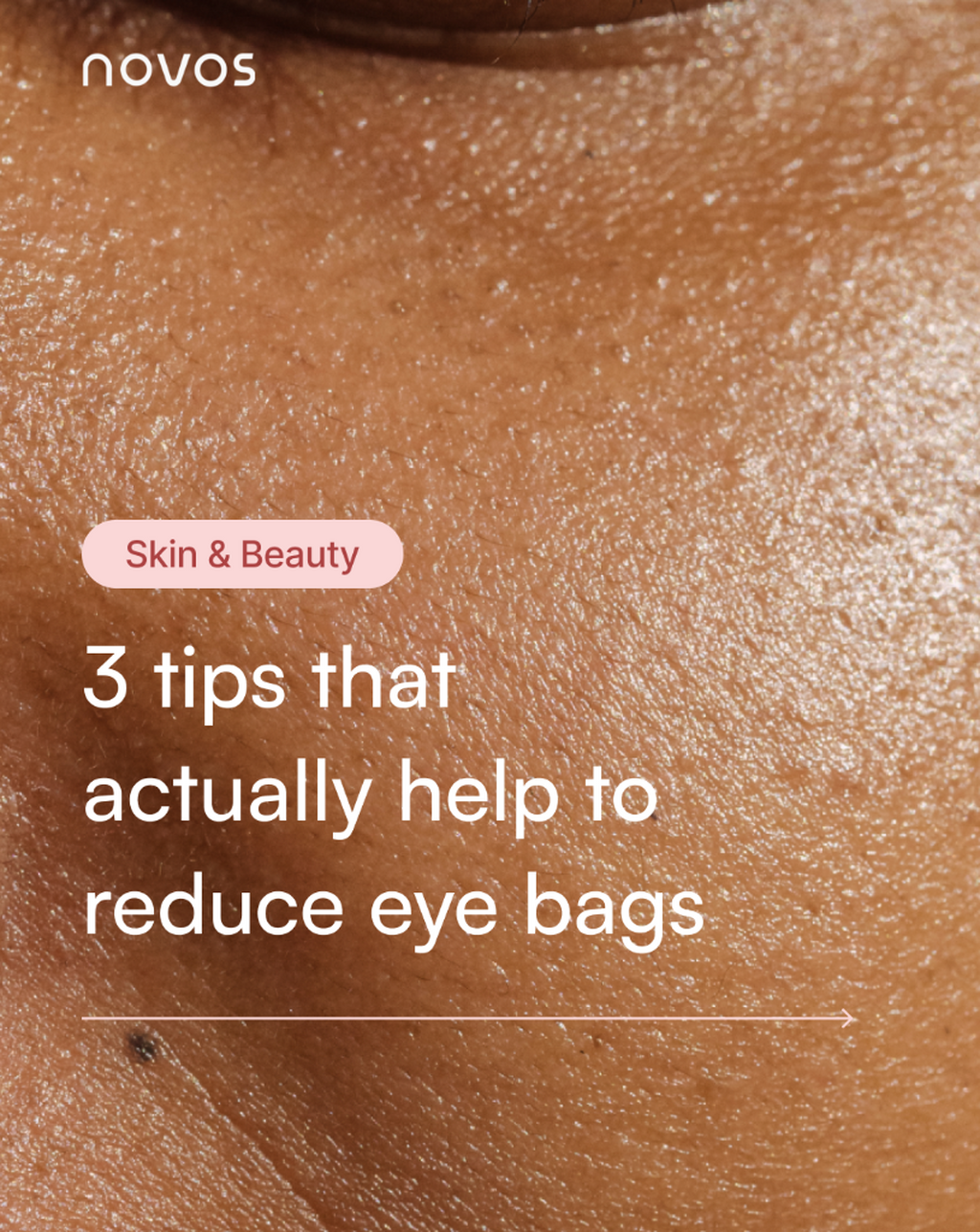 How to get rid of eye bags