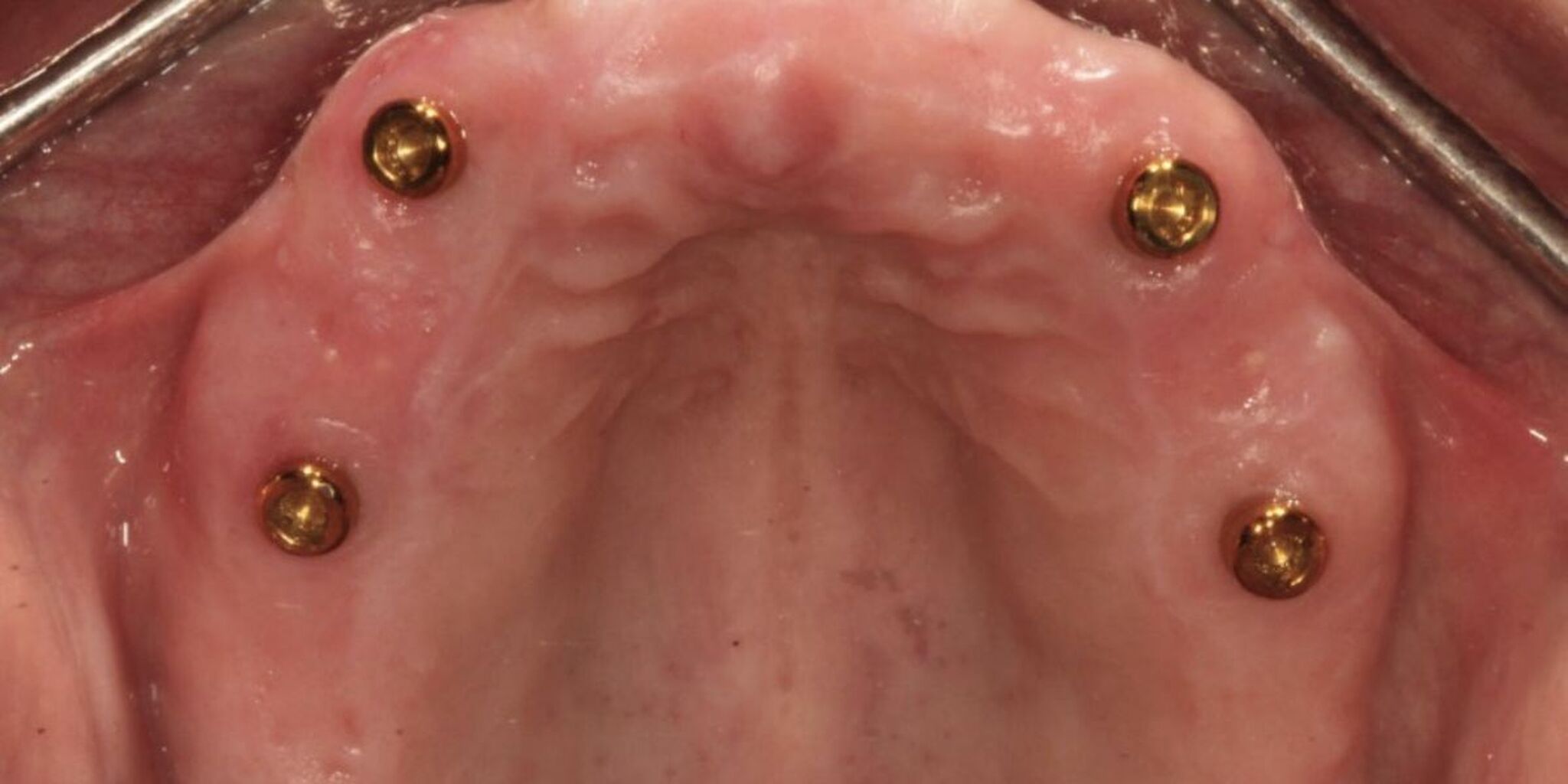 Enhancing Quality of Life: Successful Transition from LOCATOR&reg; Overdenture to LOCATOR FIXED&reg; Prosthesis