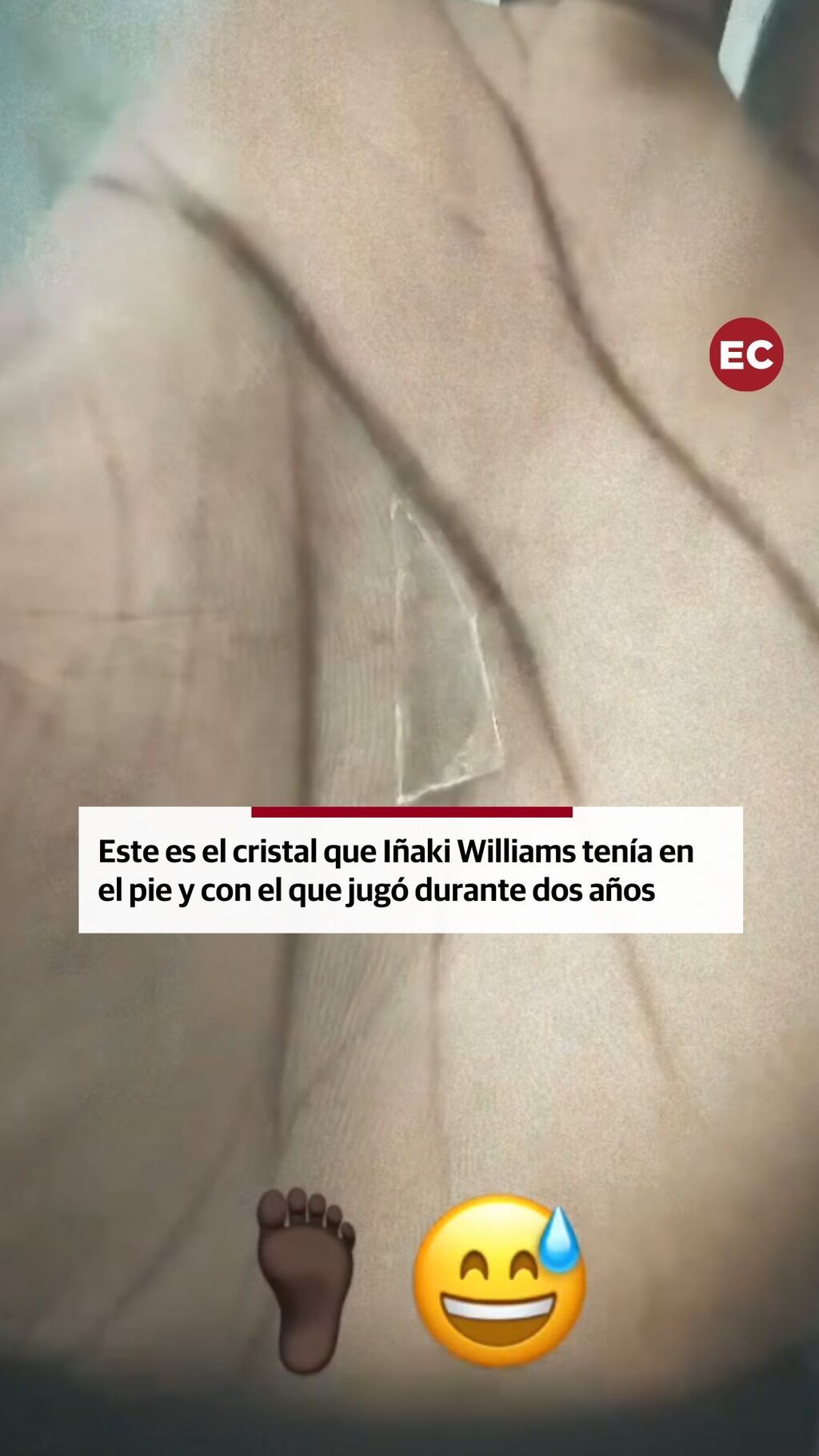 Este es el cristal que I&ntilde;aki Williams ten&iacute;a en el pie y con el que jug&oacute; durante dos a&ntilde;os