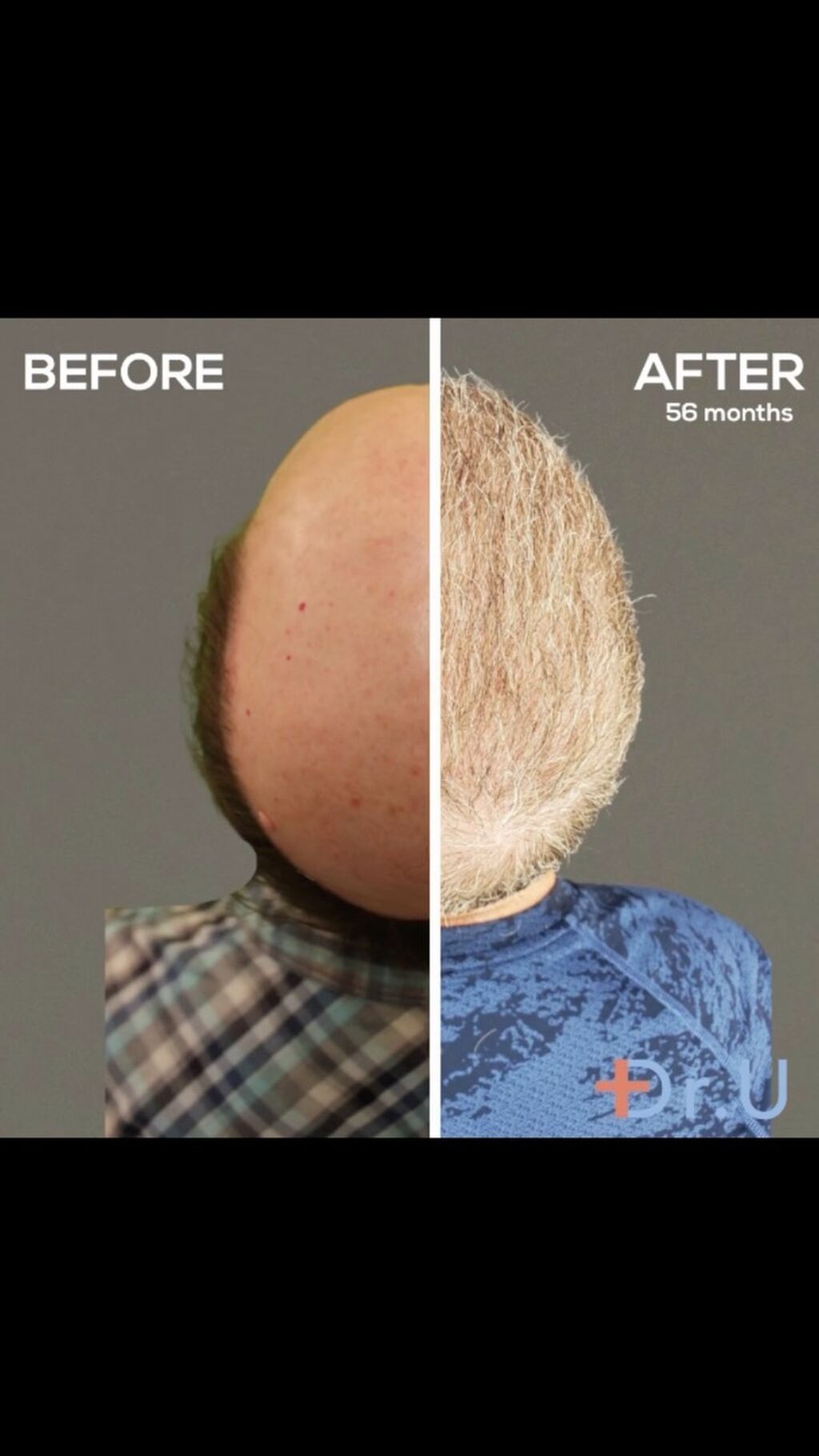 Rethinking the Impossible For Severe Baldness Worse Than Norwood 7