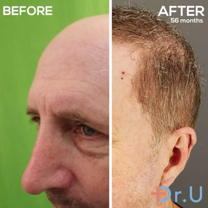 Rethinking the Impossible For Severe Baldness Worse Than Norwood 7