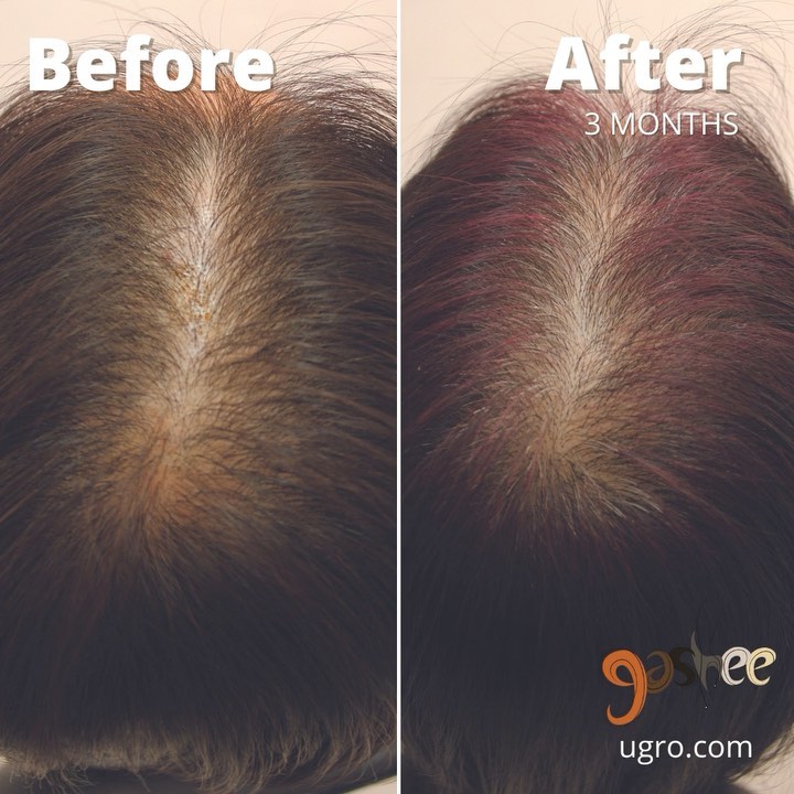 GASHEE Hair Stories: Doctor-Approved Hair Growth Results