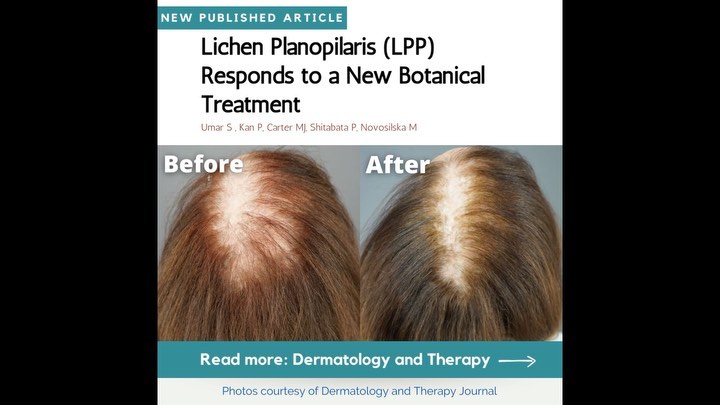 A New Universal Follicular Unit Excision Classification System for Hair Transplantation Difficulty and Patient Outcome