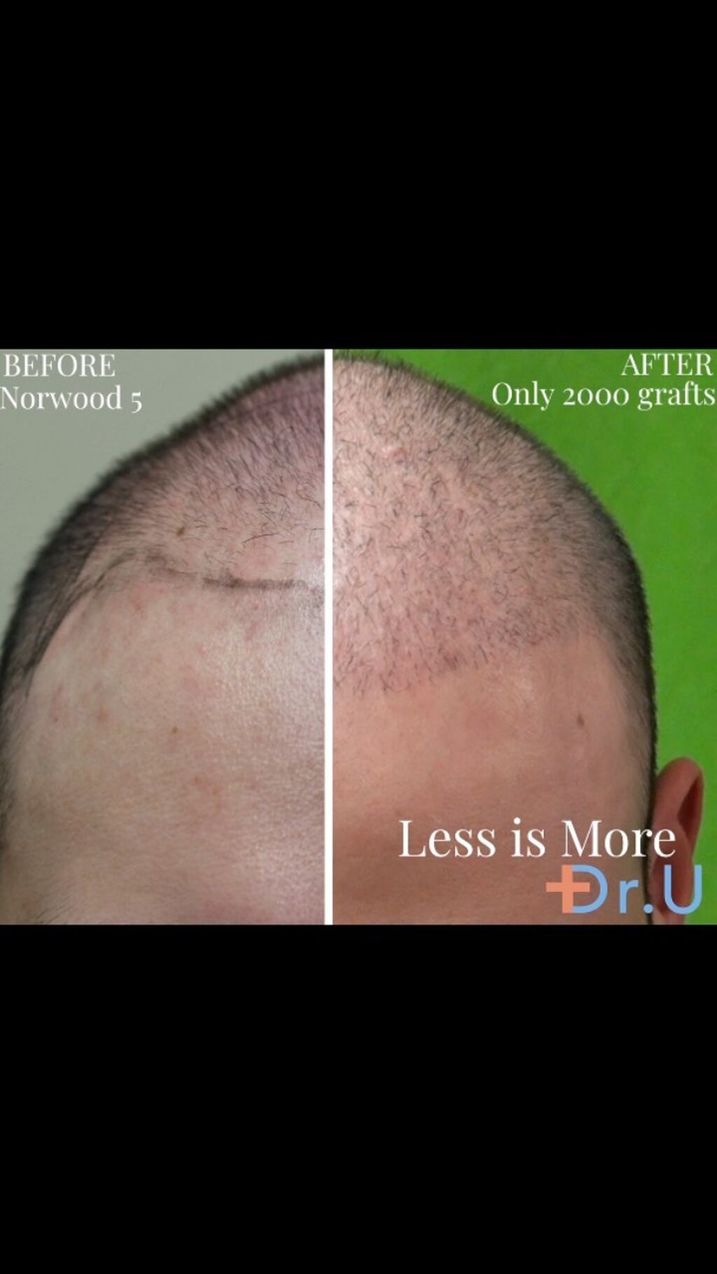 Dr. U Hair Surgery